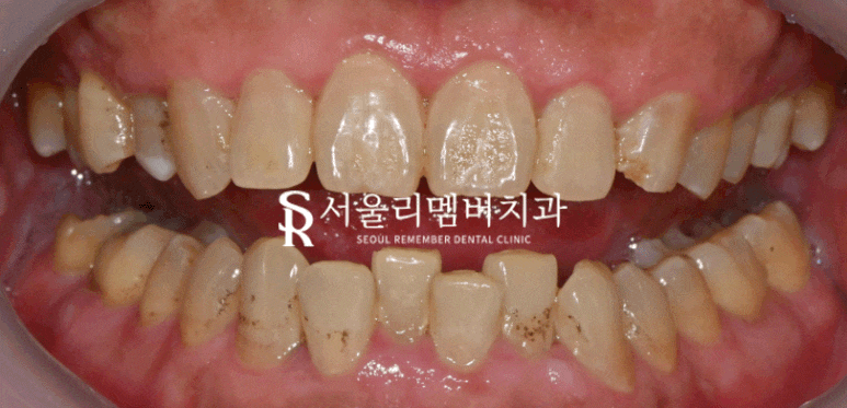 서울대입구역 치과 에서 알려드리는 스케일링의 모든 것-! 관련 이미지 1