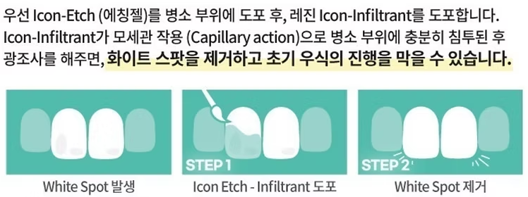 치아의 하얀 반점(화이트 스팟 white spot) 서울대입구역 치과 아이콘 레진으로 무삭제 반점치 충치 치료 관련 이미지 4