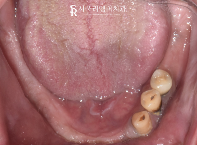 서울대입구역 치과 무너진 수직 고경 어떻게 개선했을까? 관련 이미지 4