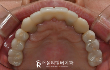 올바른 교합의 중요성, 서울대입구역치과 전체 임플란트 기간 및 과정 관련 이미지 6