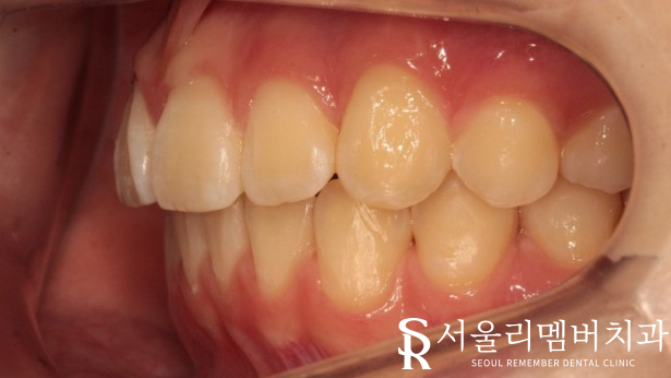 인비절라인을 사용한 치아 총생 개선 증례! 청룡동 치과 관련 이미지 13