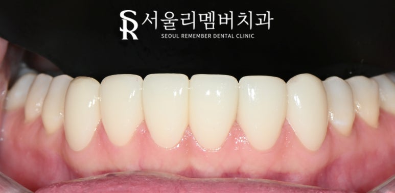 하악 전치 벌어진 공간 스페이스 해소를 위한 아래 앞니 6전치 리얼네이트 라미네이트 케이스 관련 이미지 6