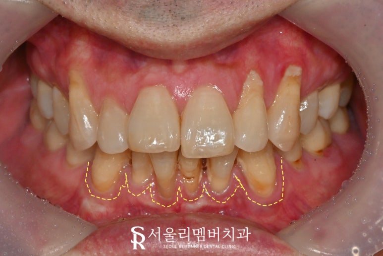 신림역 치과 앞니 크라운 및 임플란트 필요할 때 고려해야 될 요소 (비용, 기간, 개수 etc) 관련 이미지 1