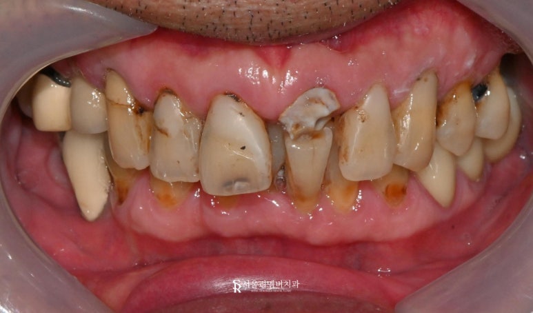 신대방 치과, 깨지고 충치가 심한 앞니 심미 크라운 수복한 증례 관련 이미지 2
