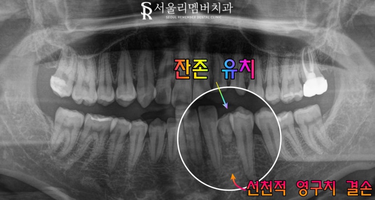 서울대입구역 치과 선천적 영구치 결손으로 잔존 유치 발치 후 브릿지 수복 케이스 관련 이미지 2