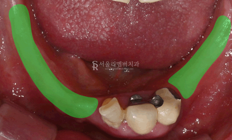 신림역 치과 "틀니는 쓰기 싫어요." 전체 임플란트 식립 후기 관련 이미지 4