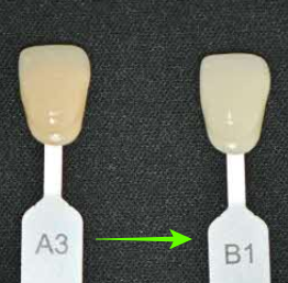 "앞니가 변색돼서 보기 싫어요" 보라매 치과 에서 미백치료 관련 이미지 4