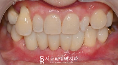 치주염으로 아래 앞니 흔들린다면? 신대방 치과 임플란트 브릿지 치료로 해결 관련 이미지 4