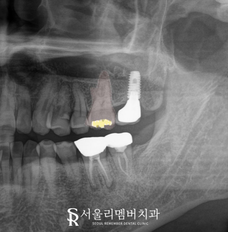 골드인레이 어금니 크랙이 있다면 신림역 치과 발치 즉시 임플란트 관련 이미지 2