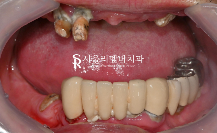 전체 보철을 할 수 밖에 없었던 이유, 서울대입구역 치과 교합 되살리기 관련 이미지 4