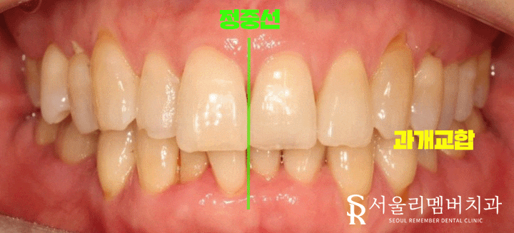 40대 교정 지금 시작해도 늦지 않을까요? 서울대입구역 치과 관련 이미지 6