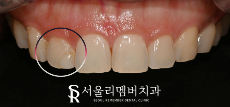상도동 치과 충치나 치아 깨짐 해결 원탑 레진의 한계는? 주의 사항 및 재치료 방법 관련 이미지 1