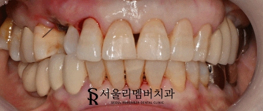 깨진 앞니를 어떤 방법으로 개선하는 게 좋을까? 서울대입구역 리멤버 치과 관련 이미지 2