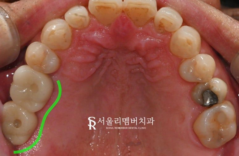 "이제 밥 먹는 것도 문제없어요!" 낙성대 치과 임플란트 로 새로운 구강 환경 찾아 드린 사례 관련 이미지 5