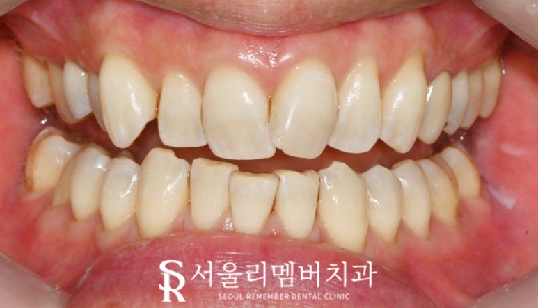 신림역 치과 스케일링 치석제거로 착색과 변색 해결하면 치아미백 만큼 하애질 수 있을까? 관련 이미지 3