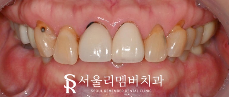 오래된 크라운 경계 불량, 이차 충치, 치경부 마모증은 앞니 라미네이트 적응증 봉천동 치과 의사 작성 관련 이미지 2