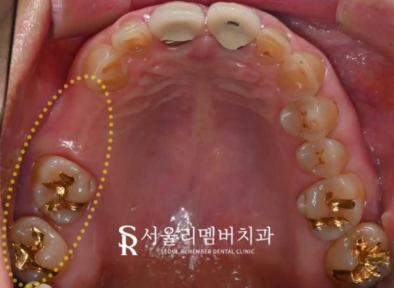"잇몸에 고름이 차고 흔들려요!" 서울대입구 임플란트 디지털 진료로 치료한 사례 관련 이미지 3