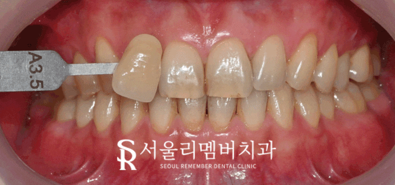 "변색 원인, 미백 방법, 주의사항까지" 서울대입구역 치과 에서 알려주는 하얀 치아를 위한 모든 것 관련 이미지 6