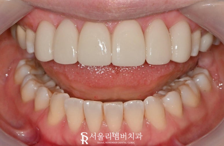 신림역 치과 상악 6전치 리얼네이트 초기 충치 화이트스팟 반점치 라미네이트로 우식 제거 후 보철 수복 과정 관련 이미지 6