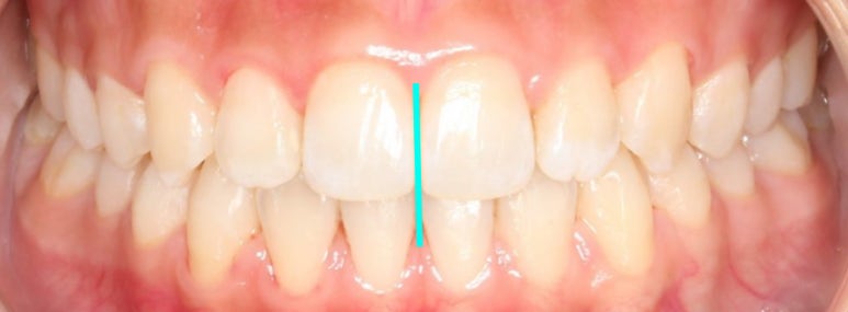 조기접촉 교정 후 관련 이미지 1