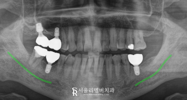 "이제 밥 먹는 것도 문제없어요!" 낙성대 치과 임플란트 로 새로운 구강 환경 찾아 드린 사례 관련 이미지 6