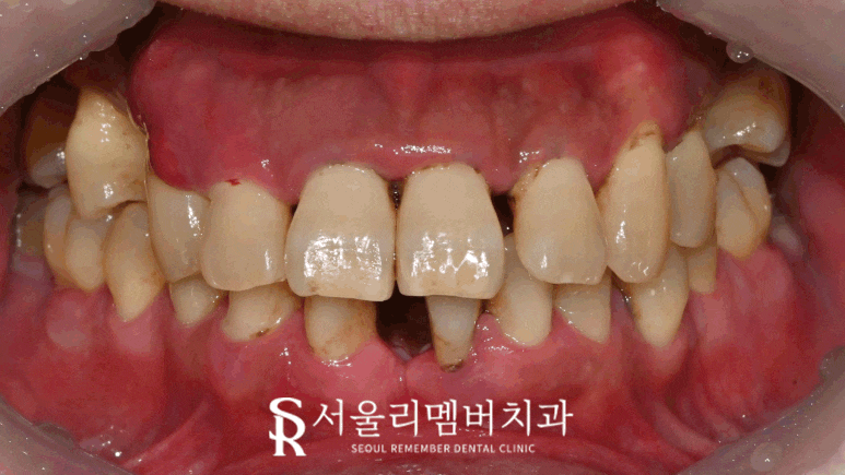 치아 빠지고 흔들리는 어금니와 치주 질환으로 통증 생긴 구강, 관악구 치과 상악 전체 임플란트 및 하악 신경치료 크라운 진행 과정 관련 이미지 10