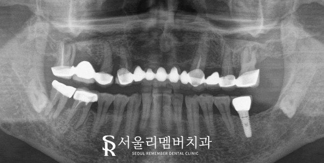 오래된 전체 브릿지 방치하면 이런 문제를 일으킬 수 있습니다. 서울대입구역 치과 풀케이스 치료 과정 관련 이미지 1