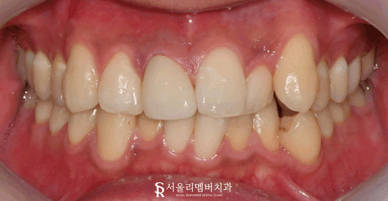 서울대입구역 치과 치아 뿌리 끝 근단 농양 염증 및 인접면 우식 있던 앞니 신경치료 후 크라운으로 자연스럽게 심미성 회복 관련 이미지 3