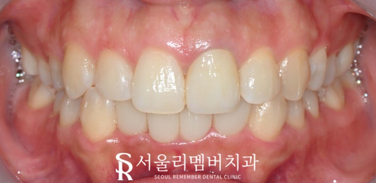 교정이 부담스러운데 치아 삐뚤빼뚤 총생 있다면 봉천역 치과 전치부 리얼네이트와 앞니 크라운 관련 이미지 6