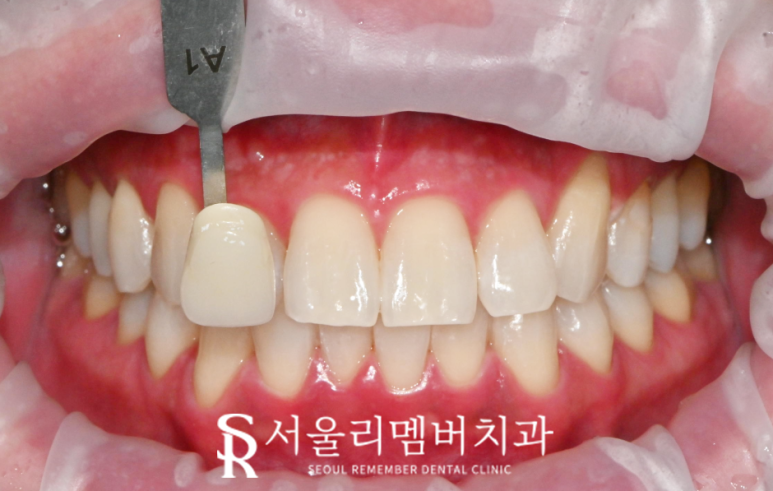 누런 이가 고민이라면? 봉천동 치과 전문가 원데이 치아미백으로 해결 관련 이미지 2