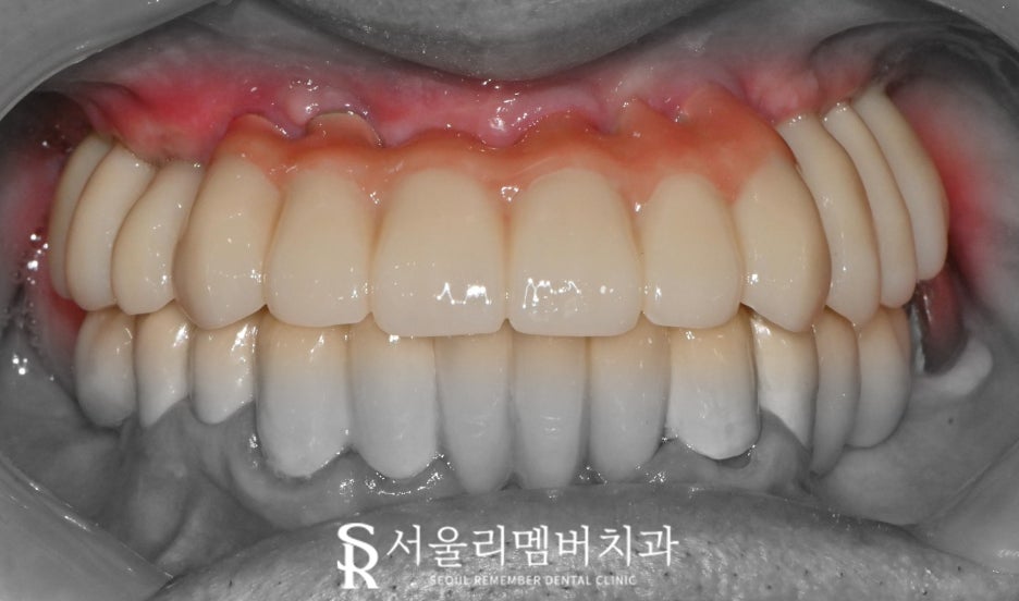 서울대입구역 치과 대표원장이 직접 봐드리는 무치악 환자 전체 임플란트 치료 케이스 관련 이미지 6