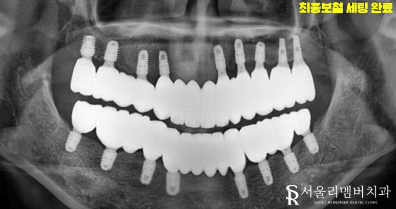 금방이라도 빠져버릴 것 같은 치아들, 전체임플란트 식립으로 개선했던 이야기. 이수역 서울 리멤버 치과 관련 이미지 6