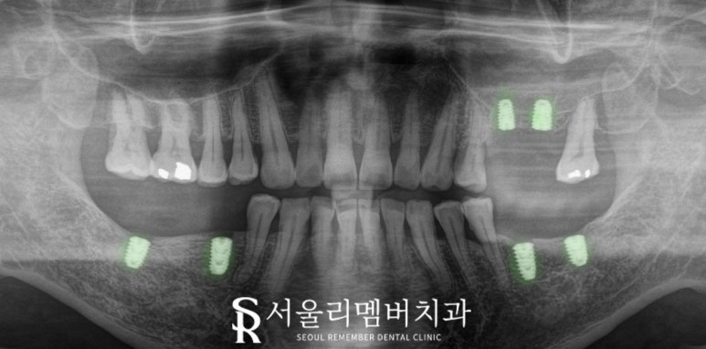 해외 거주하는 한국인, 임플란트 치료는 국내에서 받고 싶다면? 상도동 치과 수술 계획 및 과정 관련 이미지 5
