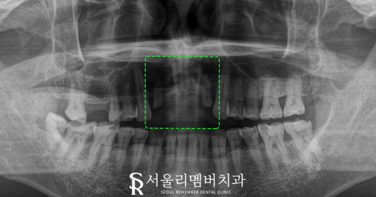 서울대입구역 치과 오래된 브릿지 부러진 앞니 발치 후 네비게이션 임플란트 식립 사례 관련 이미지 2