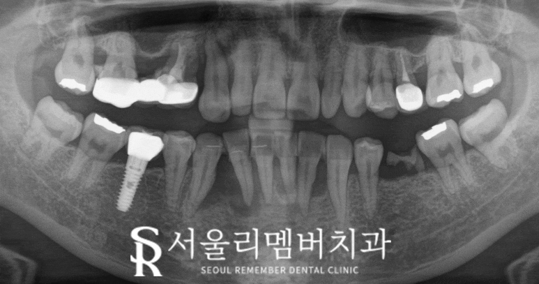 치주염으로 아래 앞니 흔들린다면? 신대방 치과 임플란트 브릿지 치료로 해결 관련 이미지 2