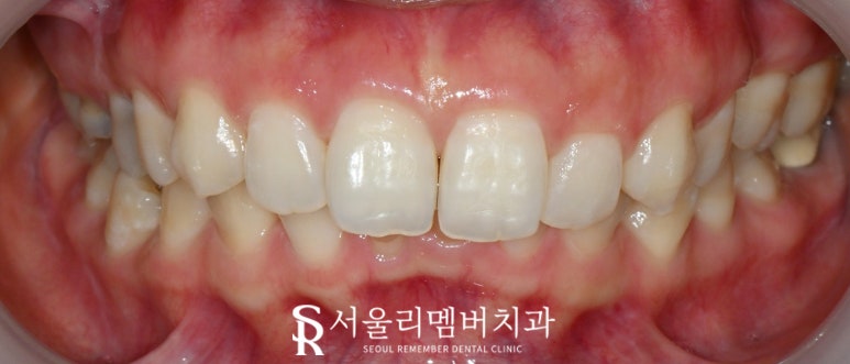 사당 치과 아래 앞니 만기 잔존 유치 크라운과 리얼네이트 동시에 심미 보철 치료 관련 이미지 5