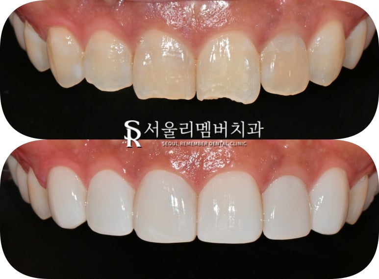 Maxillary Six-Anterior Veneers with RealNate for a Chipped Front Tooth with a Sharp, Rough Edge image 5