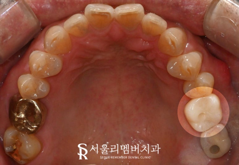 골드인레이 어금니 크랙이 있다면 신림역 치과 발치 즉시 임플란트 관련 이미지 3