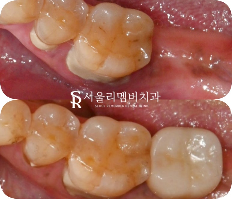 잃어버린 치아, 봉천동 치과 임플란트로 되찾는 자연스러운 미소와 건강한 저작 기능 관련 이미지 5