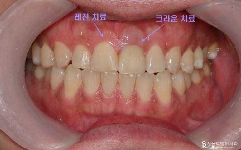 A Front Tooth Broken While Exercising: Crown Restoration After Root Canal Treatment at Boramae Dental Clinic image 2