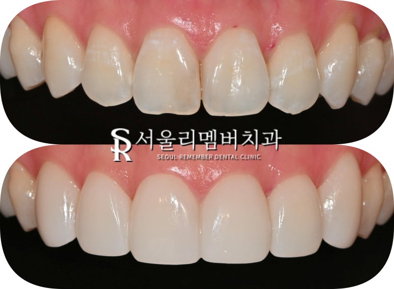 Concerned About the Color and Shape of Your Front Teeth? Seoul National University Station Dental Clinic—Maxillary Six Anterior Veneers Extending to the Canines image 6