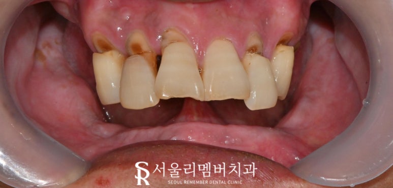 서울대입구역 양심 치과, 최소 비용으로 전체 임플란트 수술 관련 이미지 1