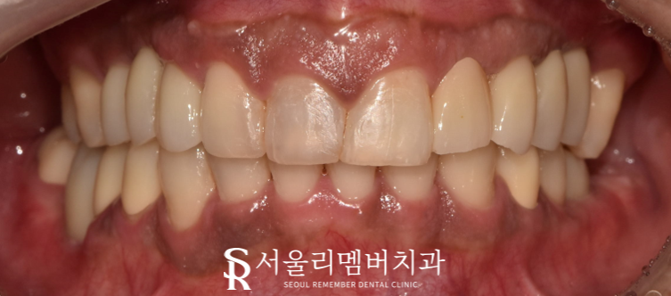 임플란트와 치아교정, 동시에 치료받을 수 있을까요? 남성역 서울 리멤버 치과 관련 이미지 8