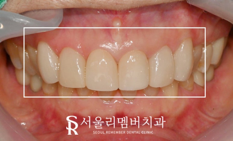 앞니 크라운, 무삭제 리얼네이트로 치열 및 톤 개선 신림 치과 최소삭제 라미네이트 당일 치료 관련 이미지 3