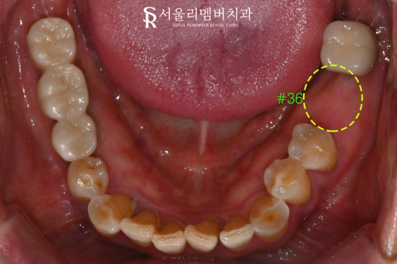 임플란트 잘하는 서울대입구역 치과 , 수면치료로 편안한 진료과정 관련 이미지 1