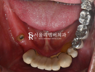 전체 보철을 할 수 밖에 없었던 이유, 서울대입구역 치과 교합 되살리기 관련 이미지 3