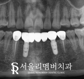 서울대입구역치과 에서 아래 앞니 5개를 임플란트 2개만으로 자연스럽게 회복 관련 이미지 3