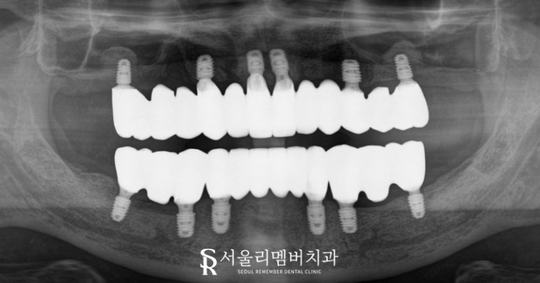 서울대입구역 양심 치과, 최소 비용으로 전체 임플란트 수술 관련 이미지 8