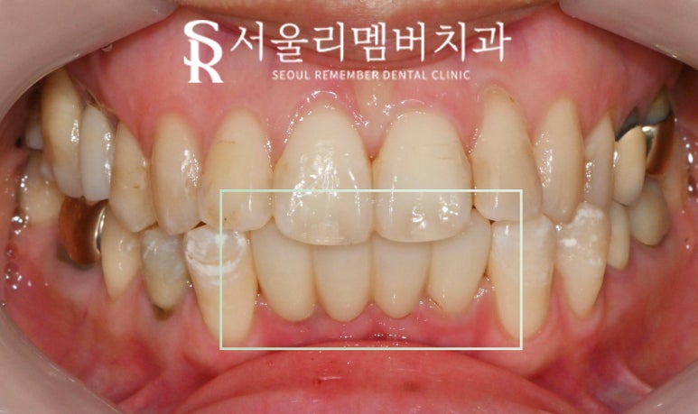 아래 앞니 부러짐 뿌리 끝 염증 봉천동 치과 하악 4전치 발치 후 오스템 임플란트 관련 이미지 6