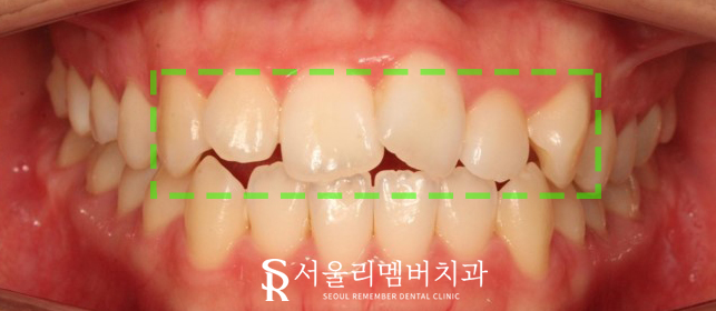 서울대입구역 치과 툭 튀어나온 돌출 때문에 발치교정 진행 관련 이미지 1